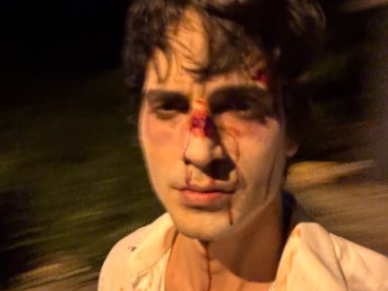 Fiuk assusta fãs ao surgir com o rosto machucado em foto publicada nas redes