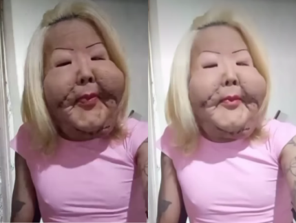 Juju do Pix relata complicação após cirurgia para retirar óleo mineral do rosto