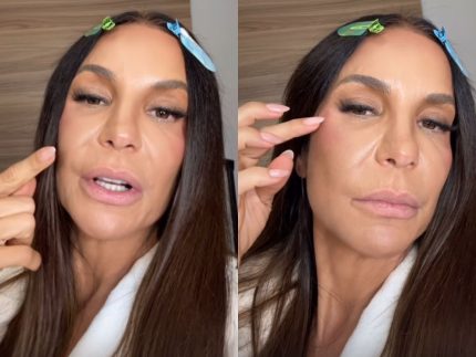 Ivete Sangalo atualiza recuperação após cirurgia no rosto e anuncia dias de folga